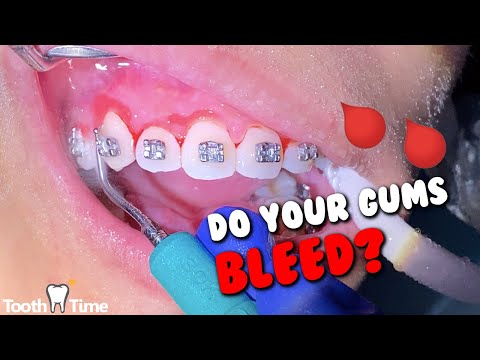 How do you get rid of inflamed gums with braces?