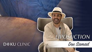 Doc Samad ile Liposuction \u0026 Saç Ekimi Deneyimi