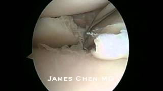 Partial Meniscectomy after Failed Bucket Handle Repair from Vertical ACL Tunnel Placement