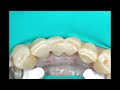 how to fabricate a periodontal splint or fixed orthodontic retainer.