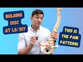 L5-S1 Bulging Disc Pain Pattern Explained!