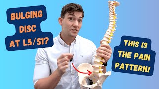 L5-S1 Bulging Disc Pain Pattern Explained!