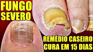 RECEITA PARA CURAR FUNGOS NAS UNHAS ONICOMICOSE VAI MATAR TODA MICOSE DA UNHA   EM POUCOS DIAS