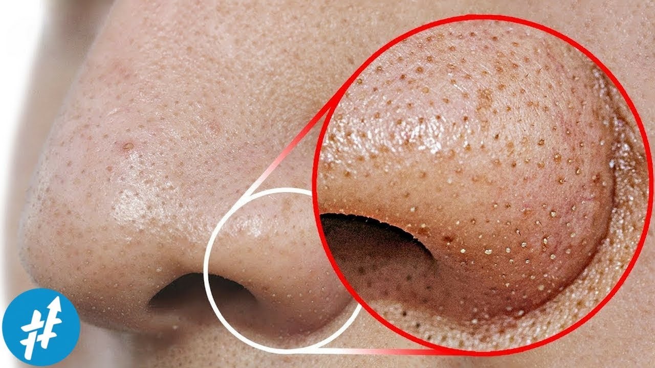 KOMEDO HITAM Di Hidung? Lakuin Hal Ini Untuk Membersihkannya Secara ...