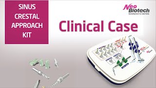 SLA Kit ACM bone + Calpore Implant placement at left upper molars with C reamer in SLA kit