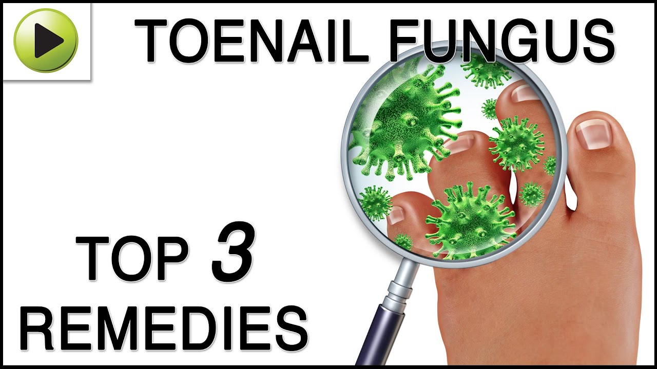 Toenail Fungus - Natural Ayurvedic Home Remedies - YouTube