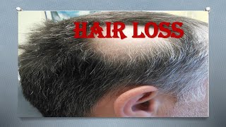 Hair loss or Alopecia (गंजापन या बालों का झड़ना) Types and Causes in Hindi