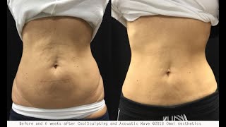 Body Contouring with CoolSculpting and Liposuction
