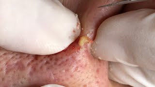 THE MOST STUBBORN BLACKHEADS | Suri Job 136