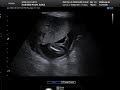 pregnancy ultrasound week 18 7 april 2020 سونوگرافی هفته ۱۸