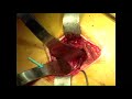 mini incision total hip arthroplasty