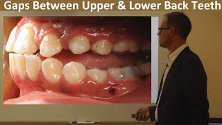 Why Do We have Gaps Between Upper & Lower Back Teeth & Its Link with Jaw Joint  by Dr Mike Mew