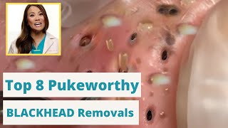 Dr. Pimple Poppers 8 WORST Blackhead Removals - You're not going to want to eat while you watch this