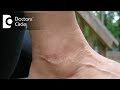 Lichen planus - Symptoms & risk factors - Dr. Amee Daxini