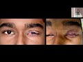 aioc2024 gp33 topic dr neha ghose eyelid malposition and management