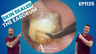 Dry, Deep & Infected Ear Wax Plug Removed!   EP1135
