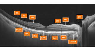 Optovue OCT Interpretation Session 1 OCT Introduction to SD OCT