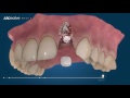 dental surgery animation bone grafting