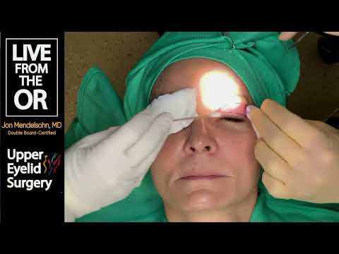 How is upper blepharoplasty performed?