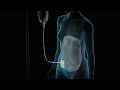 Dialysis | Nucleus Health