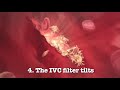 4 serious complications of ivc filter implant surgery