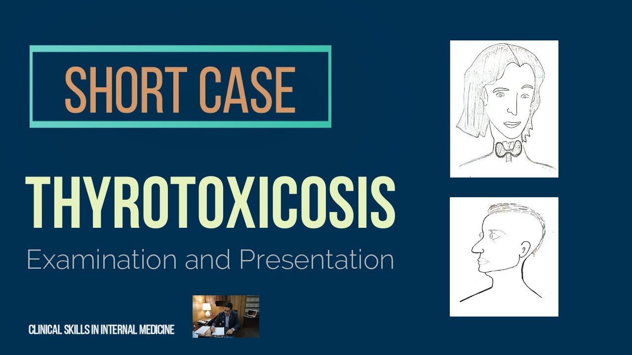 Thyrotoxicosis Short Case Youtube
