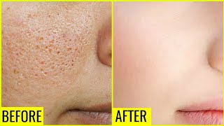 Use Glycerin This Way Your Skin Will Look So Young, Tight, Spotless & Scar Free!