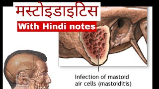 मस्टोइडाइटिस - कारण,लक्षण, नर्सिंग प्रबंधन | mastoiditis in hindi | medical surgical nursing gnm 2nd