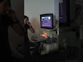 shea s ultrasound urinary bladder ub scanning techniques with bladder jets