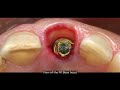 immediate implant placement u0026 loading in central incisor fresh extraction socket nobel biocare n1