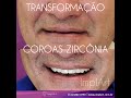 COROA ZIRCONIA PURA - O MATERIAL MAIS RESISTENTE PARA COROA DENTARIA