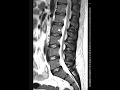 Importance of STIR images in lumbar spine