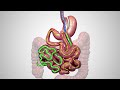 one anastomosis gastric bypass oagb animated patient education video j u0026j medtech