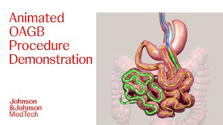 One Anastomosis Gastric Bypass (OAGB) Animated Patient Education Video | J\u0026J MedTech