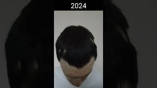 My Hair Loss Progression (On Top) [Alopecia] 2021-2024