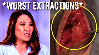 The WORST Dr. Pimple Popper Extractions (PART 2)