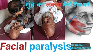 facial paralysis ko kaise accupuncture se theek Karen. मुंह का लकवा एक्यूपंक्चर से कैसे ठीक करें