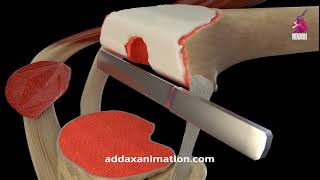 Knee Replacement Surgery 3D animation