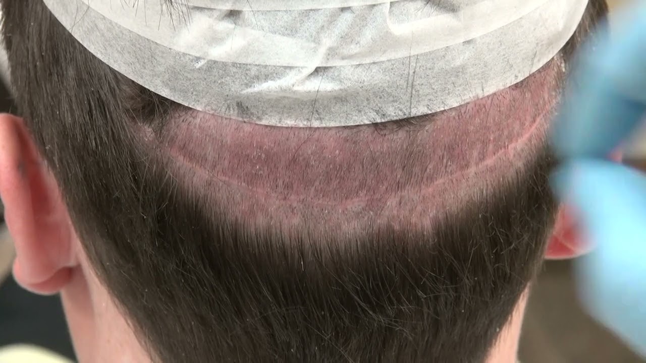 FUT Linear Donor Scar Example By Dr. John Diep - YouTube