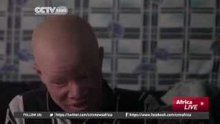 Tanzania: Albinos Fear For Their Lives As October Elections Draws Near