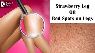 Strawberry leg | Red Bumps and Spots on Legs - Dr. Rashmi Ravindra |Doctors' Cir