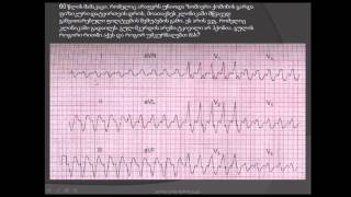 ეკგ / ფართოკომპლექსიანი ტაქიკარდია / ფილტვების შეშუპება / ელექტრული კარდიოვერსია / დიამორფინი