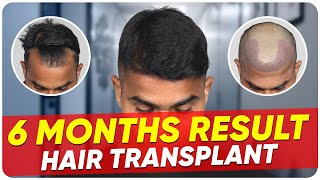 Hair Transplant in Hubli | Best Results \u0026 Cost of Hair Transplant in Hubli