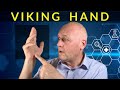 Dupuytren’s Contracture : All about the ‘Viking Hand’