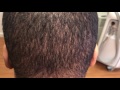 african american post fue donor evaluation