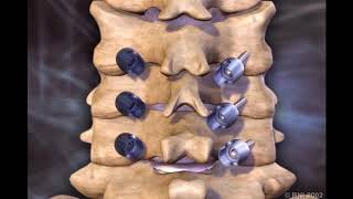 Cervical Lateral Mass Screws