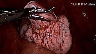 Laparoscopic Ovarian Cystectomy for Large Ovarian Cyst