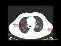 ct anatomy of left lung