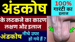 अंडकोष के लटकने का कारण, लक्षण व् इलाज | Hanging Scrotum | Andkosh Main Derd Hota Hain ? Vericocele