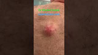 Massive cyst removal #blackheads #skincare #drkhaledsadek LIPOMACYST.com